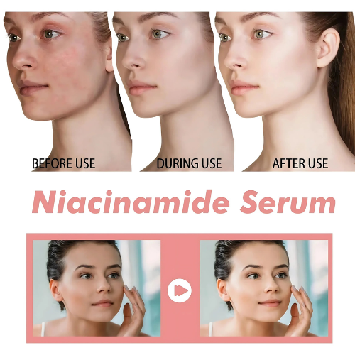 niacinamide serum for oily skin